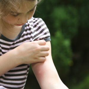 Why are some people’s mosquito bites itchier than others’? New study hints at answer