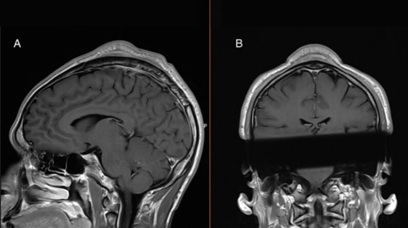 Man developed a ‘headspin hole’ after years of breakdancing, case report says