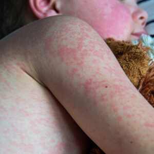 Measles outbreak erupts in one of Texas’ least vaccinated counties