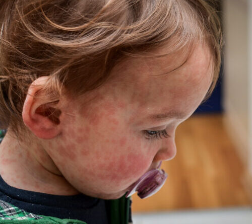 Nine unvaccinated people hospitalized as Texas measles outbreak doubles