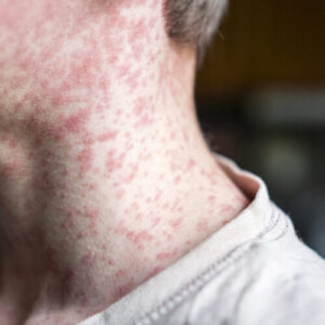 Measles outbreak in undervaccinated Texas area doubles—again