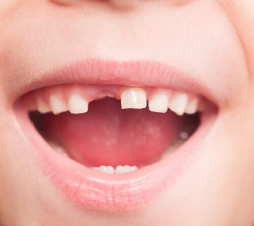 RFK Jr’s plan to ban fluoride supplements will “hurt rural America,” dentists say