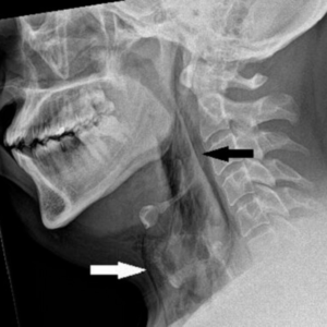 Diagnostic dilemma: A man held in a sneeze — and it punctured his windpipe