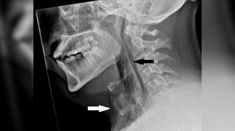 Diagnostic dilemma: A man held in a sneeze — and it punctured his windpipe
