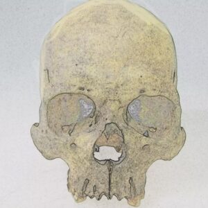 Rare form of leprosy infected people in Americas before European arrival, 4,000-year-old bones suggest