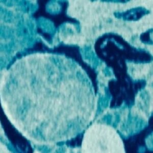 Diagnostic dilemma: Weird lump in woman’s hip was sponge left behind during C-section