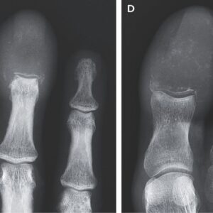 Weird swelling of man’s fingers and toes revealed cancer had ‘completely replaced’ the bones with lesions