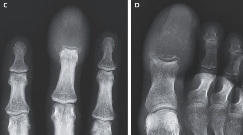 Weird swelling of man’s fingers and toes revealed cancer had ‘completely replaced’ the bones with lesions