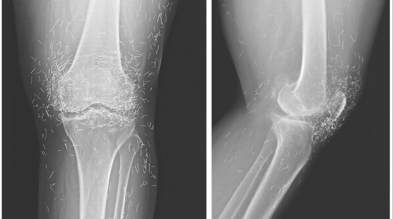 Diagnostic dilemma: Woman’s severe knee pain reveals ‘golden threads’ in her joints