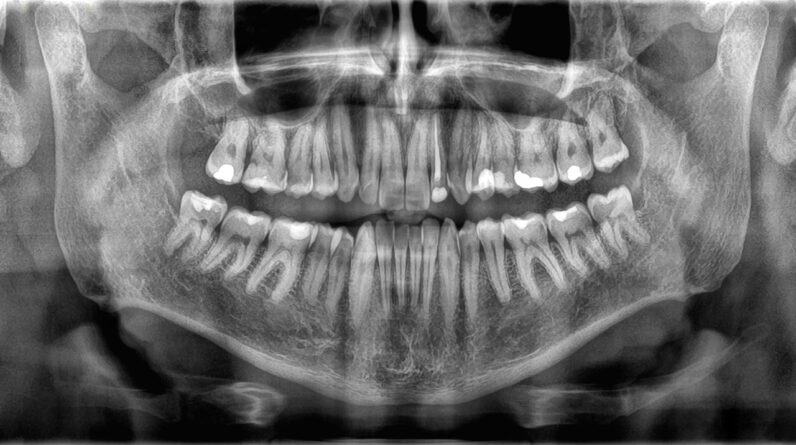 Why don’t teeth count as bones?