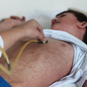 Canada has lost its ‘measles elimination status’ — here’s what that means