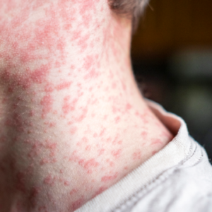 US could lose its measles elimination status within months, experts say