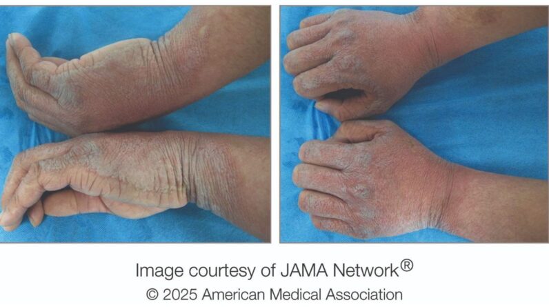 Diagnostic dilemma: A rare condition caused a man to get ‘scales’ on his hands whenever he washed them