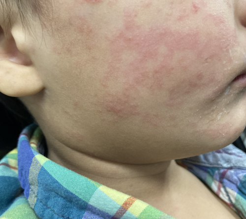 Measles continues raging in South Carolina; 99 new cases since Tuesday