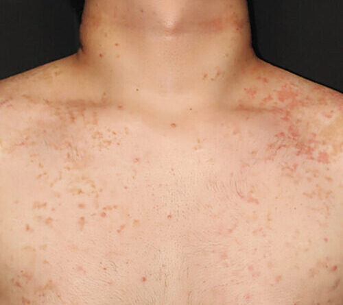 A weird, itchy rash is linked to the keto diet—but no one knows why