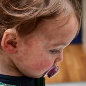 The UK has lost its measles elimination status — again