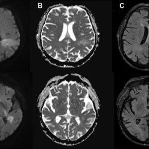 You’re likely already infected with a brain-eating virus you’ve never heard of
