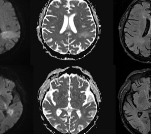 You’re likely already infected with a brain-eating virus you’ve never heard of