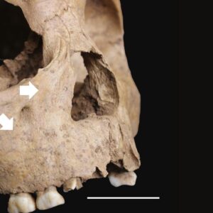 Ancient children’s teeth reveal a syphilis-like disease was spreading in Vietnam 4,000 years ago