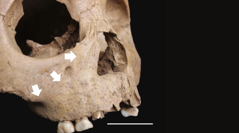 Ancient children’s teeth reveal a syphilis-like disease was spreading in Vietnam 4,000 years ago