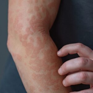 Keratin may act as a ‘brake’ for skin inflammation, pointing to potential treatments