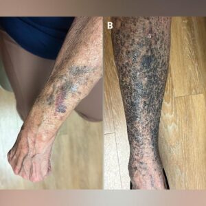 Diagnostic dilemma: A woman turned black and blue weeks after starting a new medication