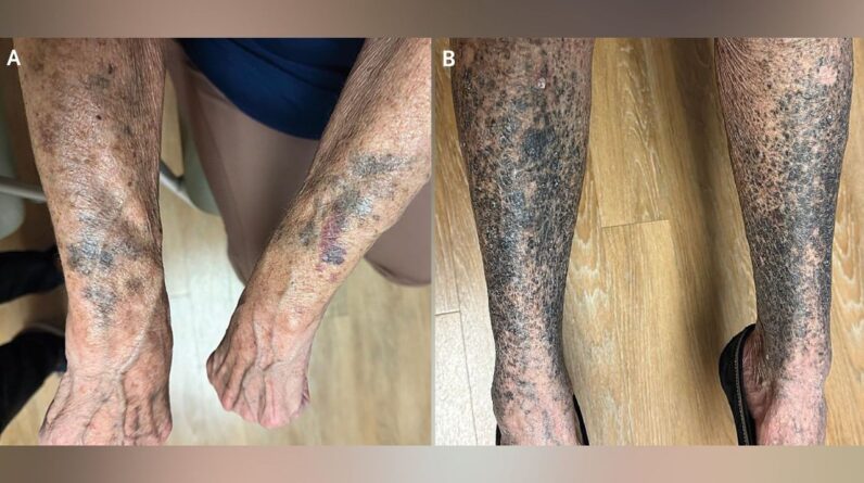 Diagnostic dilemma: A woman turned black and blue weeks after starting a new medication