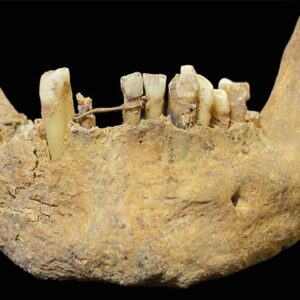 500-year-old gold dental bridge is earliest known oral care of its kind in Scotland — and it likely held a fake tooth