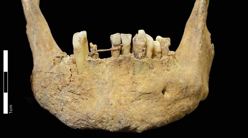 500-year-old gold dental bridge is earliest known oral care of its kind in Scotland — and it likely held a fake tooth