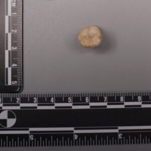 Protein in Homo erectus teeth suggests Denisovans gave us some of their DNA
