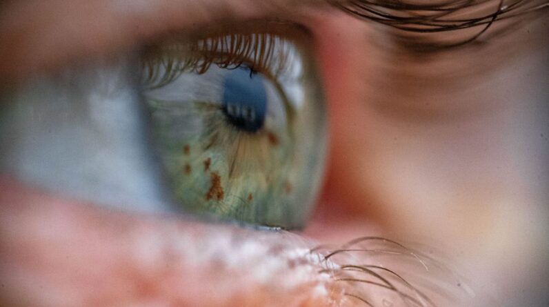 A new test could flag people at risk for anemia by filming their eyeballs — no needles required
