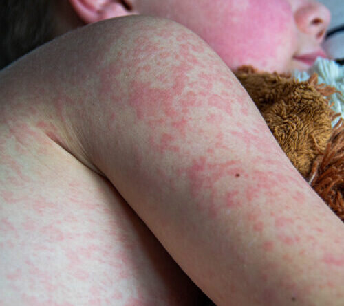 Two unvaccinated people die from measles in Pennsylvania, officials confirm