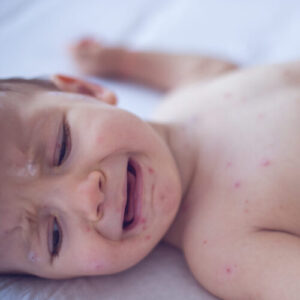 Measles killed 6-week-old baby, coroner confirms after RFK Jr. disputed deaths