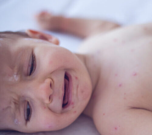 Measles killed 6-week-old baby, coroner confirms after RFK Jr. disputed deaths