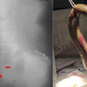 Diagnostic dilemma: Fisher’s colon punctured by eel that snuck in through his rectum