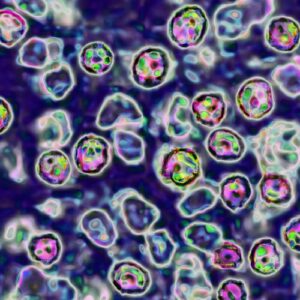 Unvaccinated Pennsylvania woman died of measles complications, coroner says