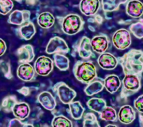 Unvaccinated Pennsylvania woman died of measles complications, coroner says