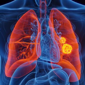 Scientists identify rare genetic mutation that dramatically raises risk of lung cancer in nonsmokers