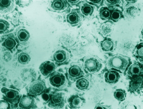 Cold Sore Virus Leaves Mark on Brain’s Immune Cells, Animal Study Shows