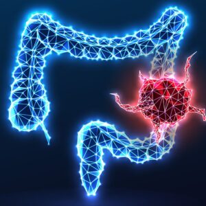 Study reveals new clues to why colorectal cancer in young people is so deadly